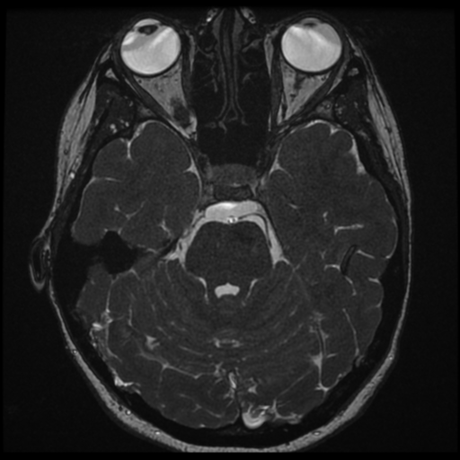 Neurofibromatosis type 2 - bilateral acoustic neuromata (Radiopaedia 40060-42566 Axial FIESTA 62).png