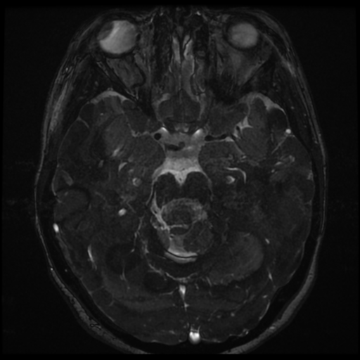 File:Neurofibromatosis type 2 - bilateral acoustic neuromata (Radiopaedia 40060-42566 Axial FIESTA 81).png
