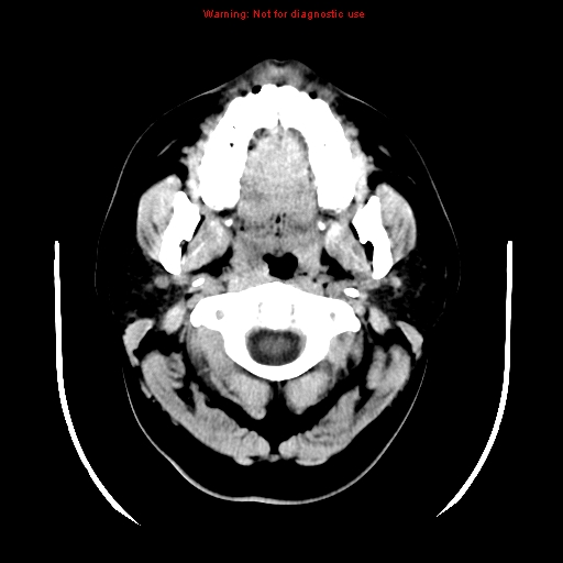 File:Neuroglial cyst (Radiopaedia 10713-11185 Axial non-contrast 33).jpg