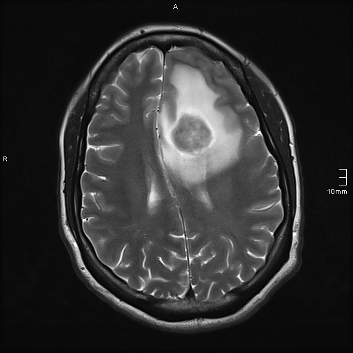 File:Neurotoxoplasmosis - concentric target sign (Radiopaedia 70644-80784 Axial T2 14).jpg