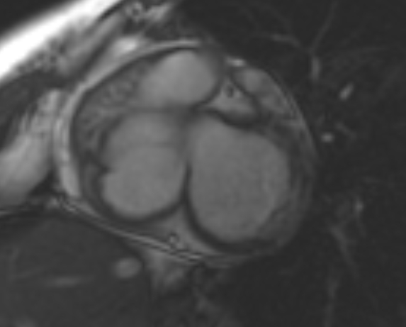 File:Non-compaction of the left ventricle (Radiopaedia 69436-79314 Short axis cine 182).jpg
