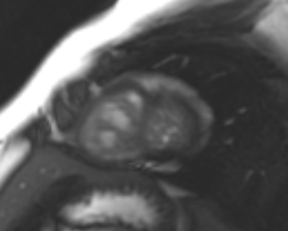 File:Non-compaction of the left ventricle (Radiopaedia 69436-79314 Short axis cine 44).jpg