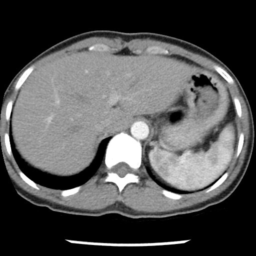 File:Non-small cell lung cancer with miliary metastases (Radiopaedia 23995-24193 A 36).jpg