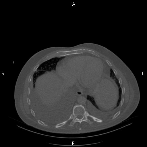 Non Hodgkin lymphoma in a patient with ankylosing spondylitis (Radiopaedia 84323-99624 Axial bone window 22).jpg