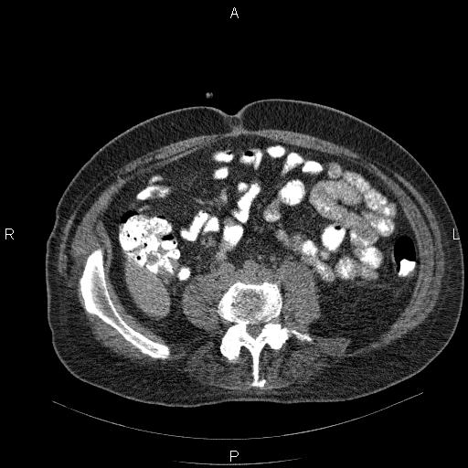 File:Non Hodgkin lymphoma in a patient with ankylosing spondylitis (Radiopaedia 84323-99624 Axial non-contrast 48).jpg