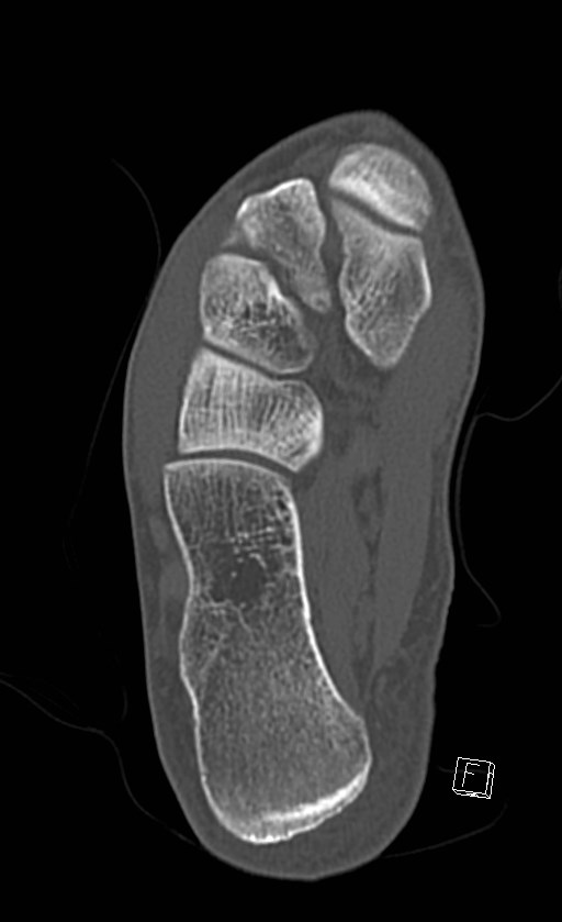 Normal CT of the ankle (Radiopaedia 47111-51658 Axial bone window 74).jpg