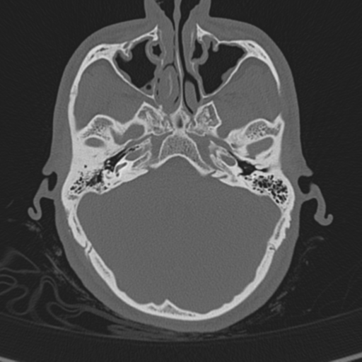 Normal CT skull (Radiopaedia 40798-43459 A 38).png