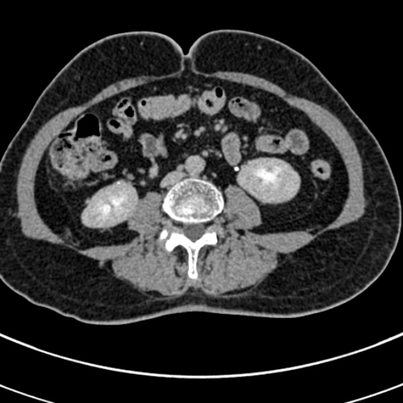 File:Normal CT split bolus study of the renal tract (Radiopaedia 48631-53634 Axial split bolus 140).jpg