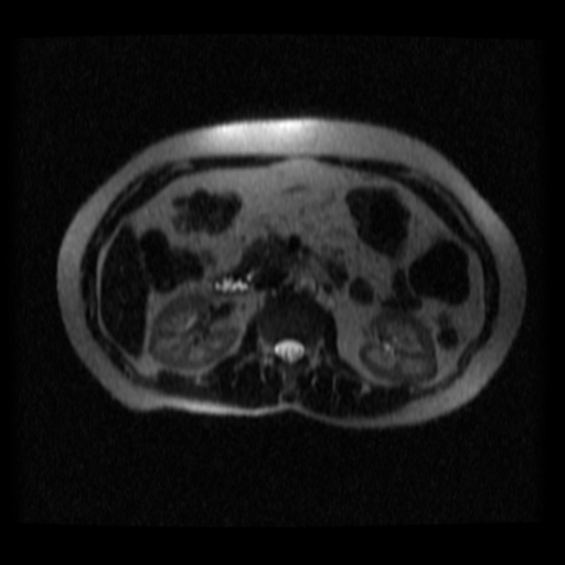 File:Normal MRCP (Radiopaedia 41966-44978 Axial T2 thins 9).png