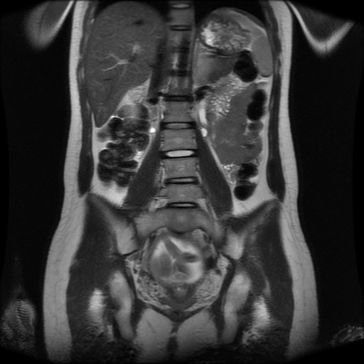 File:Normal MRI abdomen in pregnancy (Radiopaedia 88001-104541 Coronal T2 20).jpg