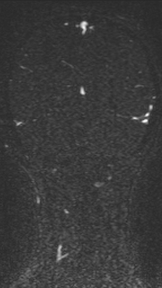 Normal MRI brain with MRV- teenager (Radiopaedia 49425-54553 Coronal MRV 183).jpg