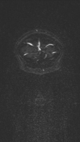 Normal MRI brain with MRV- teenager (Radiopaedia 49425-54553 Coronal MRV 39).jpg