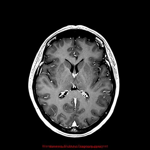 Normal adult brain MRI (non-enhanced and contrast-enhanced) (Radiopaedia 75262-86379 Axial T1 C+ 109).jpg