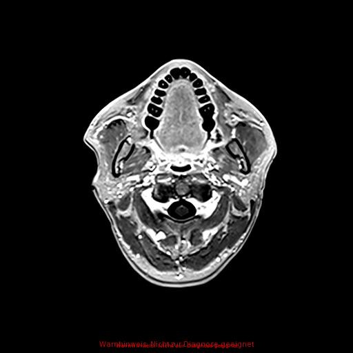 Normal adult brain MRI (non-enhanced and contrast-enhanced) (Radiopaedia 75262-86379 Axial T1 C+ 24).jpg
