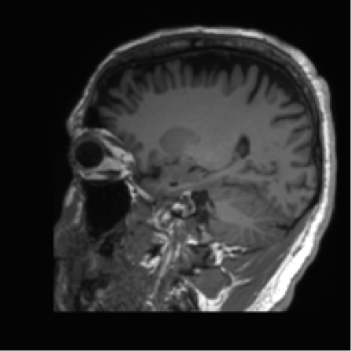 Normal brain MRI (non-focal epilepsy protocol) (Radiopaedia 53917-60040 Sagittal T1 46).png