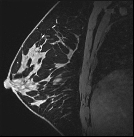 Normal breast MRI - dense breasts (Radiopaedia 80454-93850 I 113).jpg