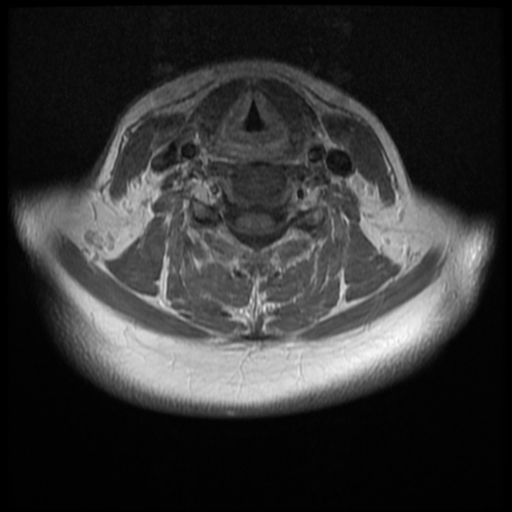 File:Normal cervical and thoracic spine MRI (Radiopaedia 35630-37156 Axial T1 C+ 16).png