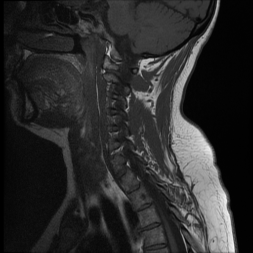 File:Normal cervical and thoracic spine MRI (Radiopaedia 35630-37156 Sagittal T1 9).png