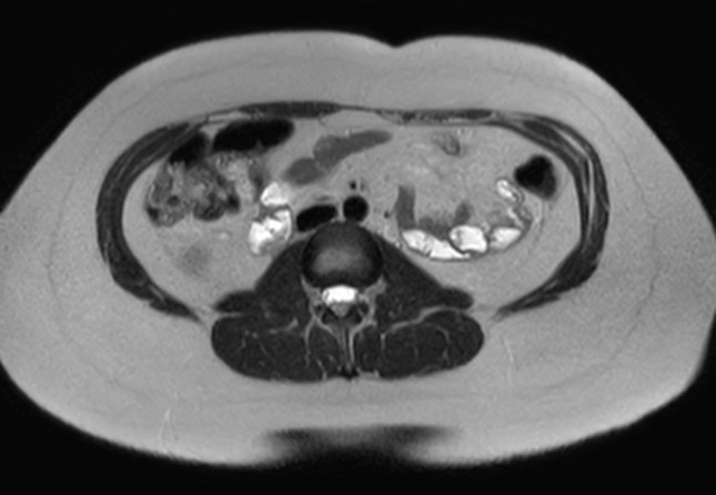 File:Normal liver MRI with Gadolinium (Radiopaedia 58913-66163 Axial T2 5).jpg