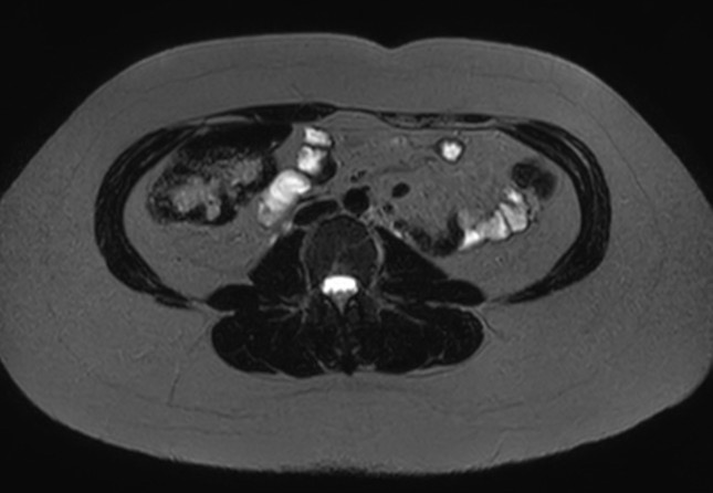 File:Normal liver MRI with Gadolinium (Radiopaedia 58913-66163 E 3).jpg