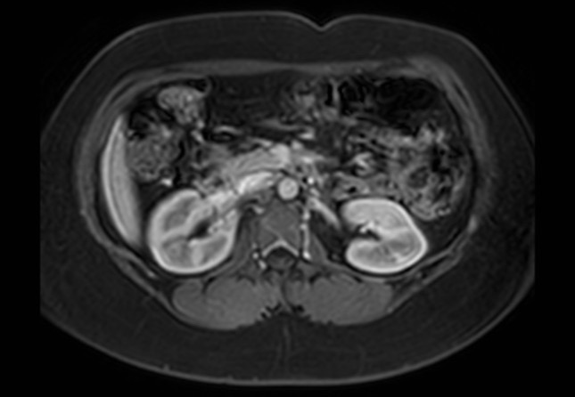 Normal liver MRI with Gadolinium (Radiopaedia 58913-66163 J 23).jpg