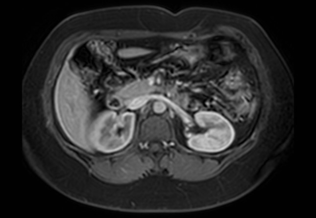 Normal liver MRI with Gadolinium (Radiopaedia 58913-66163 J 29).jpg