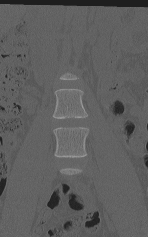 Normal lumbar spine CT (Radiopaedia 46533-50986 Coronal bone window 16).png