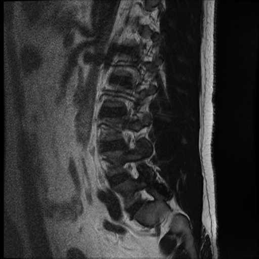 File:Normal lumbar spine MRI (Radiopaedia 35543-37039 Sagittal T2 2).png