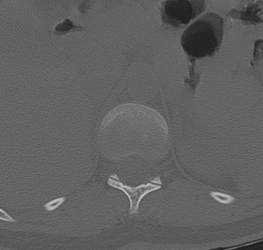File:Normal lumbosacral CT (Radiopaedia 37923-39867 Axial bone window 16).png