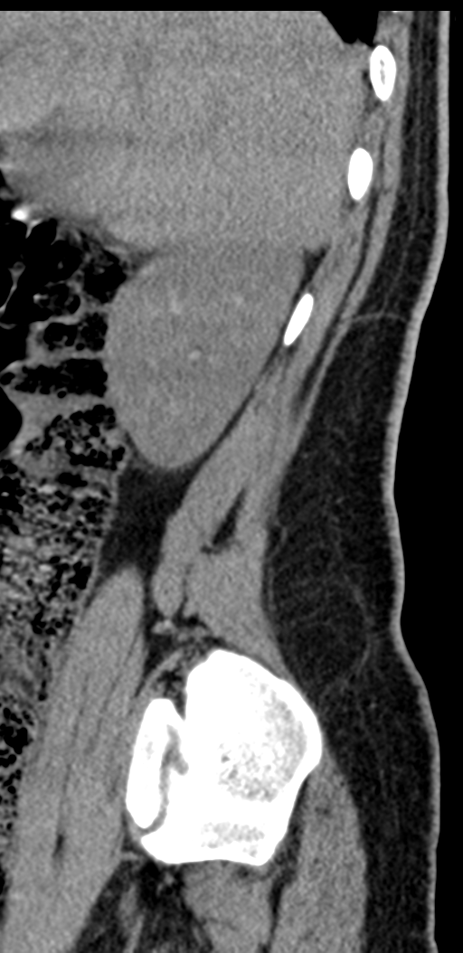 Normal lumbosacral CT (Radiopaedia 37923-39867 E 97).png