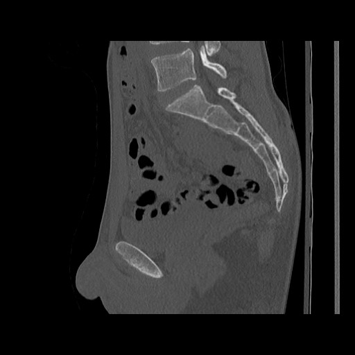 Normal pelvis (Radiopaedia 51473-57238 Sagittal bone window 71).jpg
