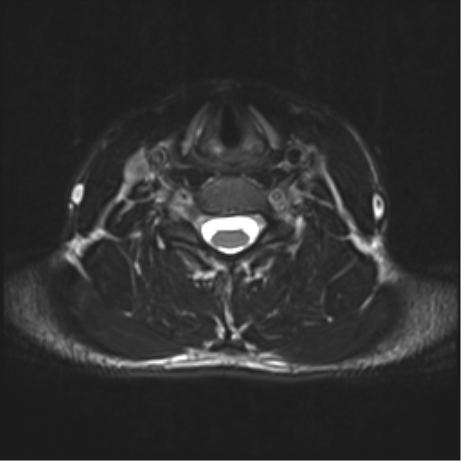 Normal trauma cervical spine (Radiopaedia 41017-43762 D 35).png