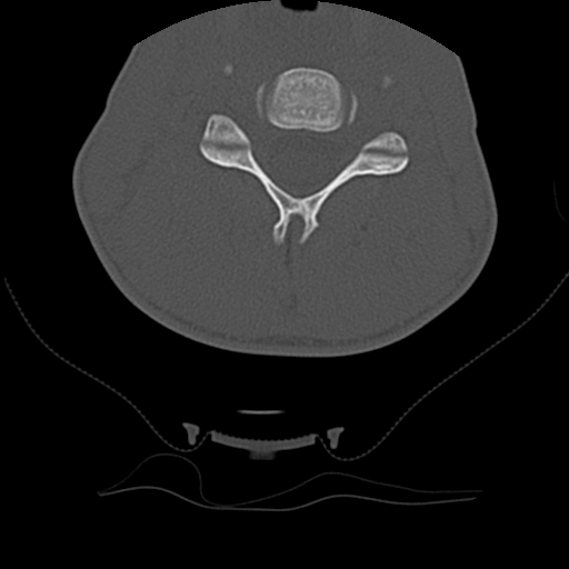 File:Normal trauma spine imaging (age 16) (Radiopaedia 45335-49358 Axial bone window 41).jpg