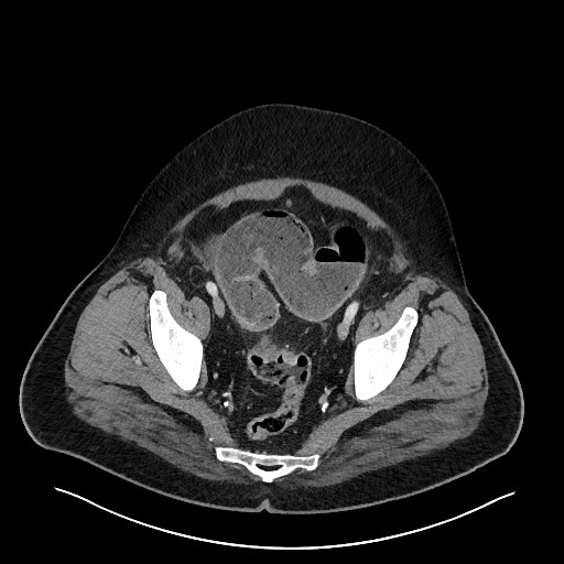 File:Obstructing sigmoid adenocarcinoma (Radiopaedia 58465-65619 A 140).jpg