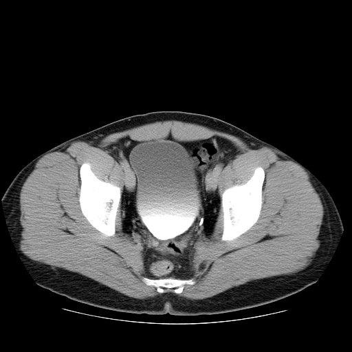 Obstructing ureteric calculus (Radiopaedia 18615-18514 D 50).jpg
