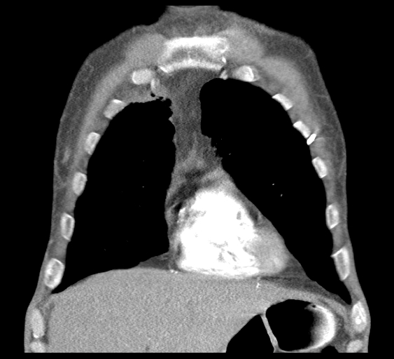 File:Obstructive superior vena cava tumor thrombus (Radiopaedia 28046-28306 B 12).jpg