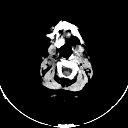Occipital encephalocele (Radiopaedia 87339-103636 Axial non-contrast 4).jpg