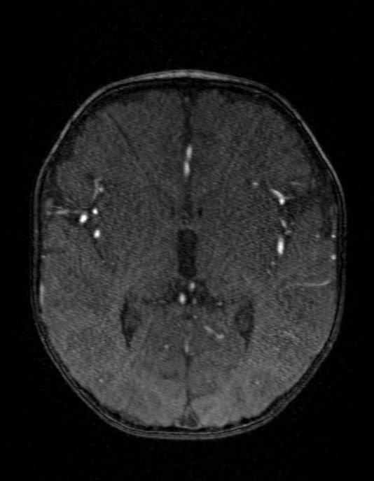 Occipital horn syndrome (Radiopaedia 14255-14129 MRA 84).jpg
