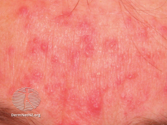 Rosacea (DermNet NZ acne-red-face-3639).jpg