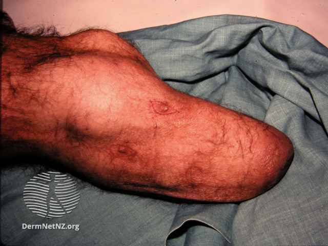 File:Squamous cell carcinoma on limb of amputee (DermNet NZ reactions-amputation-stump-13).jpg