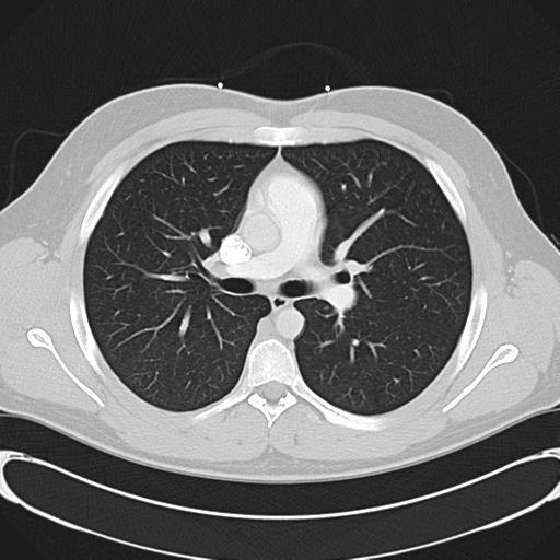 'Bovine' aortic arch (Radiopaedia 33554-34637 Axial lung window 26).png