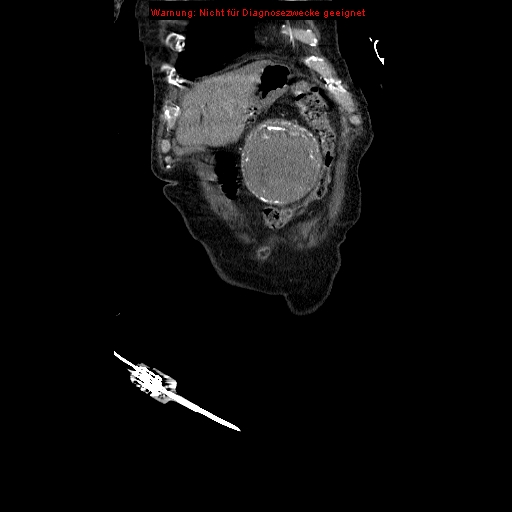Abdominal aortic aneurysm- extremely large, ruptured (Radiopaedia 19882-19921 Coronal C+ arterial phase 14).jpg