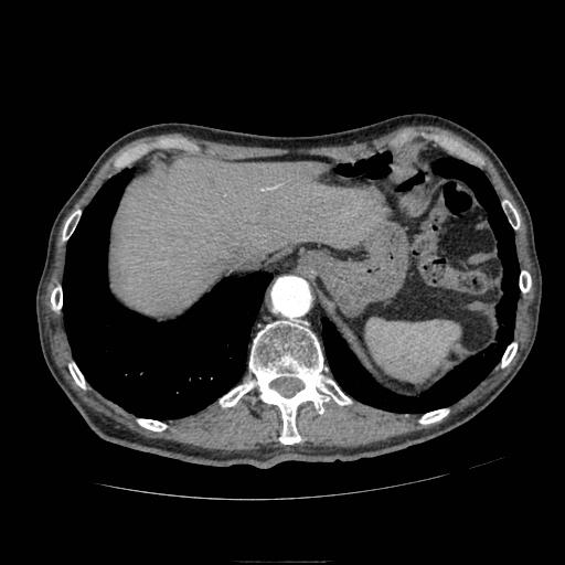 File:Abdominal aortic aneurysm (Radiopaedia 13341-13340 Axial C+ arterial phase 23).jpg