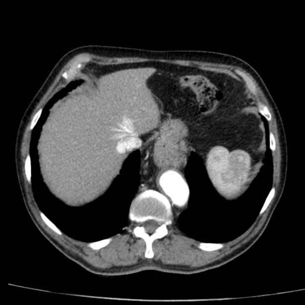 Abdominal aortic aneurysm (Radiopaedia 29248-29660 Axial C+ arterial phase 11).jpg
