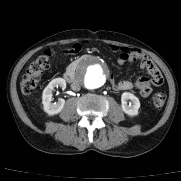 Abdominal aortic aneurysm (Radiopaedia 29248-29660 Axial C+ arterial phase 44).jpg