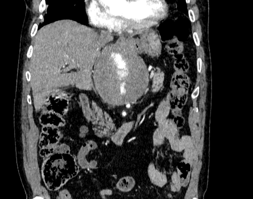 Abdominal aortic aneurysm (Radiopaedia 67117-76452 Coronal C+ arterial phase 34).jpg