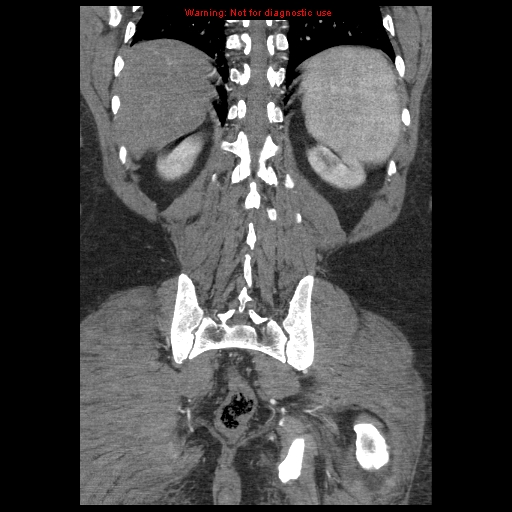 Abdominal aortic aneurysm (Radiopaedia 8190-9038 Coronal C+ arterial phase 103).jpg