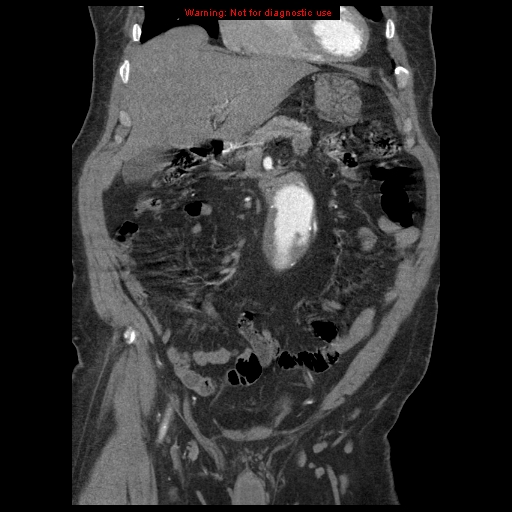 Abdominal aortic aneurysm (Radiopaedia 8190-9038 Coronal C+ arterial phase 39).jpg