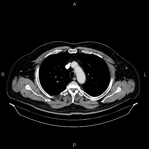 File:Abdominal aortic aneurysm (Radiopaedia 83094-97462 Axial renal cortical phase 22).jpg