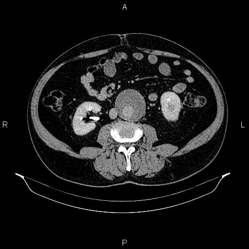 File:Abdominal aortic aneurysm (Radiopaedia 83094-97462 Axial renal excretory phase 58).jpg